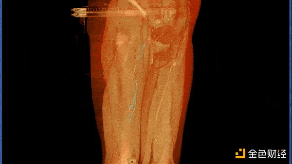 全国首例  “元宇宙”可视化皮瓣移植术成功实施  医生像开了透视眼